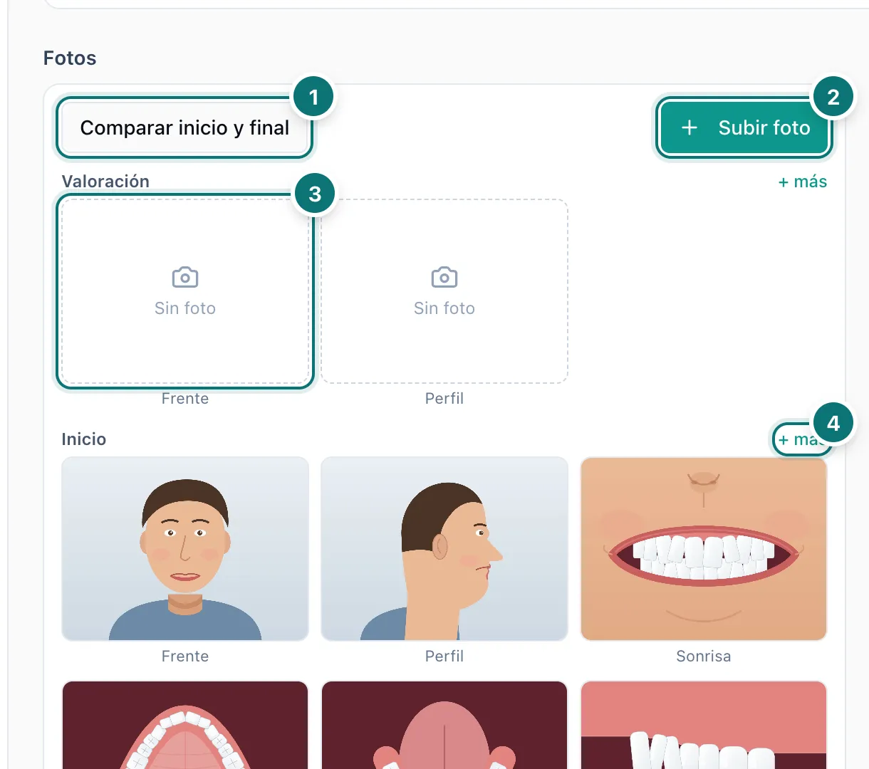 Tarjeta de fotos de ortodoncia con los botones Comparar inicio y final y Subir foto, un espacio vacío de la sesión de valoración y el enlace más, numerados del 1 al 4