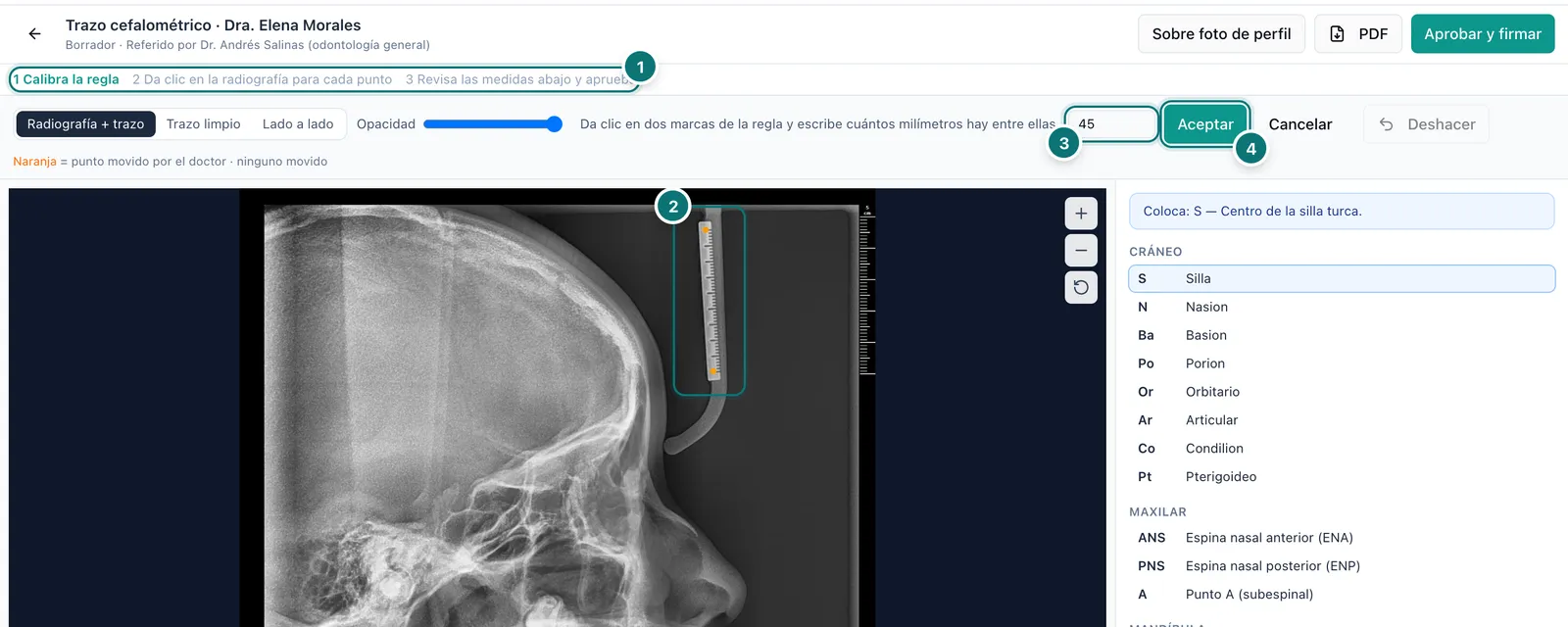 Calibración en curso: la barra de pasos en Calibra la regla, las dos marcas sobre la regla de la radiografía, el campo de milímetros y el botón Aceptar, numerados del 1 al 4