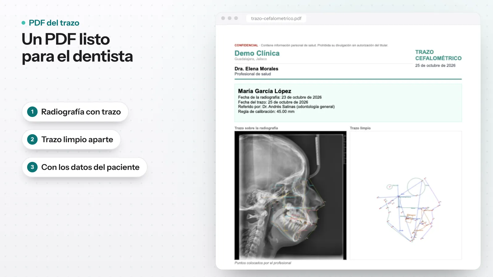 PDF del trazo cefalométrico con los datos del paciente, la radiografía con el trazo y el trazo limpio aparte, listo para enviar al dentista